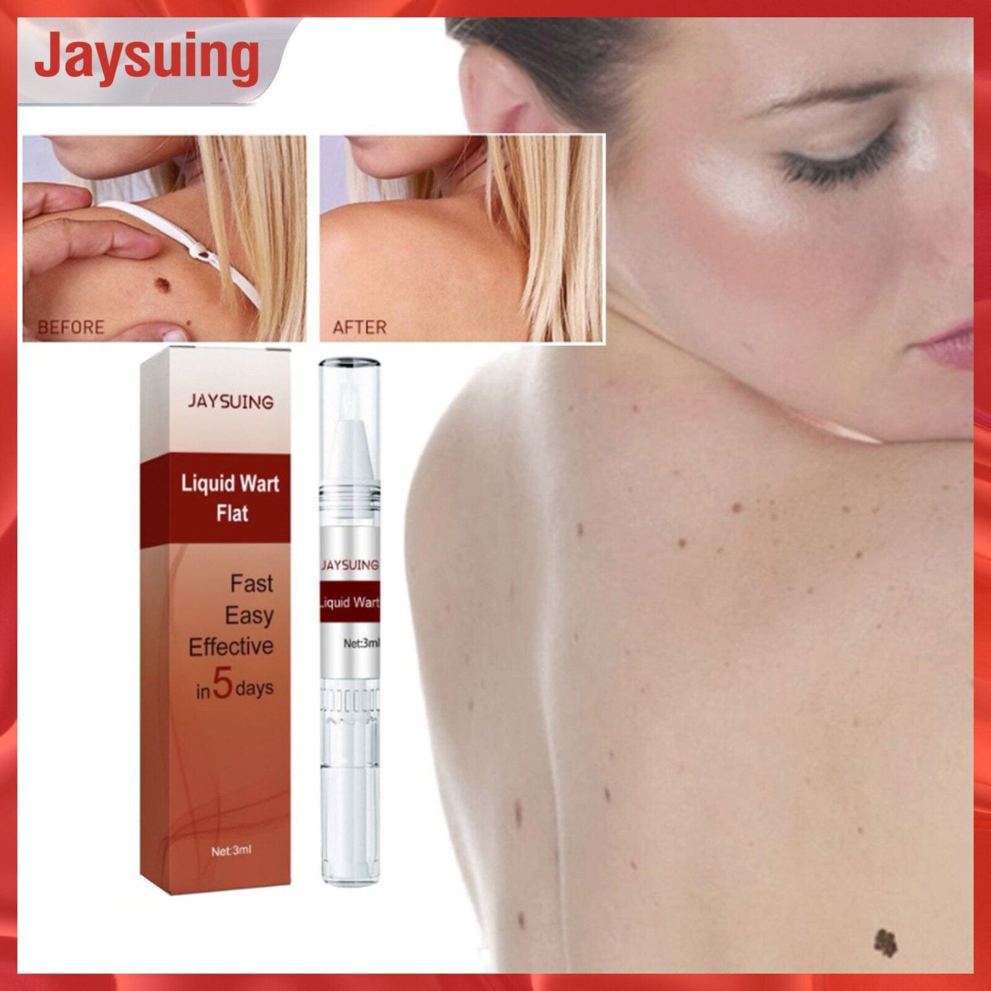 Professional Skin Tag & Mole Removal Device – Flawless Skin At Home